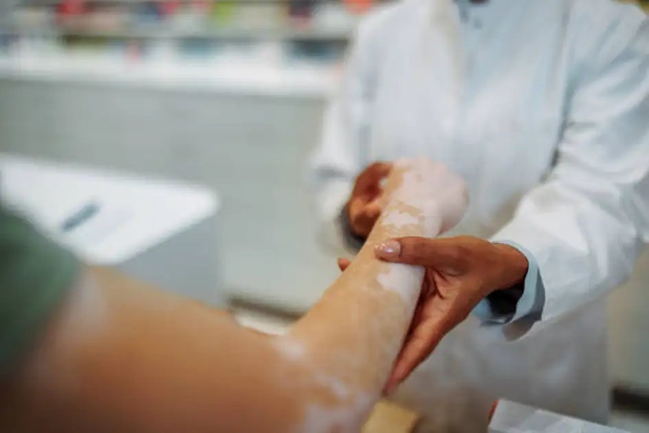 UAE becomes first in the world to approve pill to treat non-segmental vitiligo