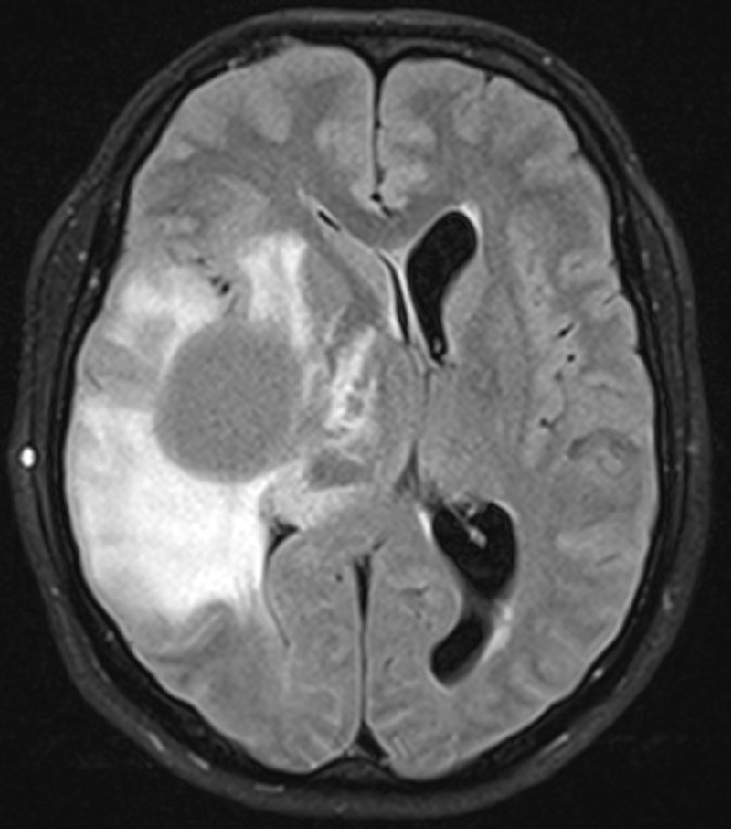 Vaccine Against Brain Tumors Shows Promising Long-Term Results