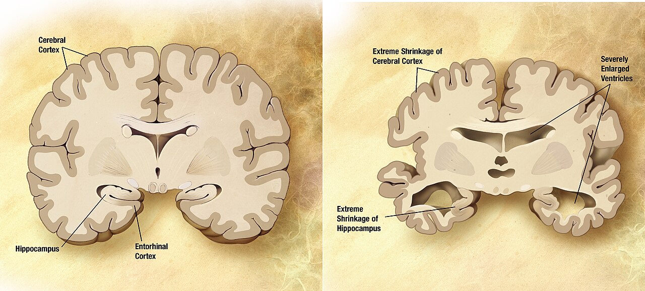 HRT Reduces Alzheimer's Risk by 16% in Study of 180,000 Women